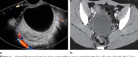 Ovarian Torsion Semantic Scholar