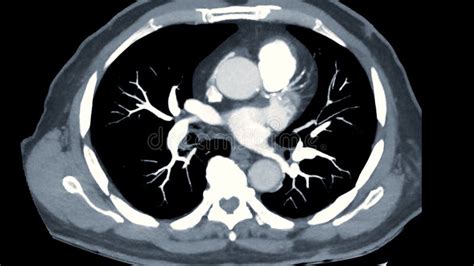 CTPA Or CTA Pulmonary Artery This Imaging Technique Offers A Clear