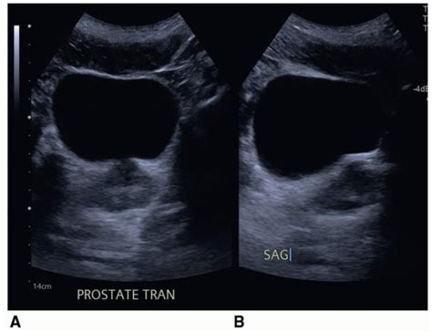 The Lower Urinary Tract Radiology Key