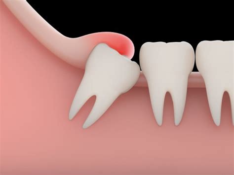 Estrazione Denti Del Giudizio Clinica Dentistica Di Como