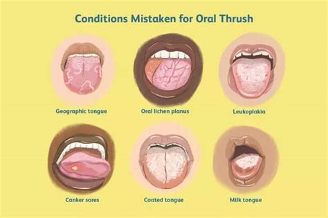 Tongue Thrush News Dentagama