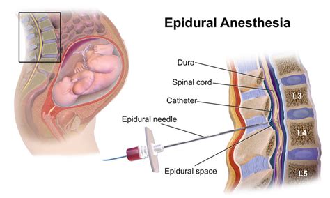 Lumbar Epidural Space Location Left And Tissues From Epidural Region