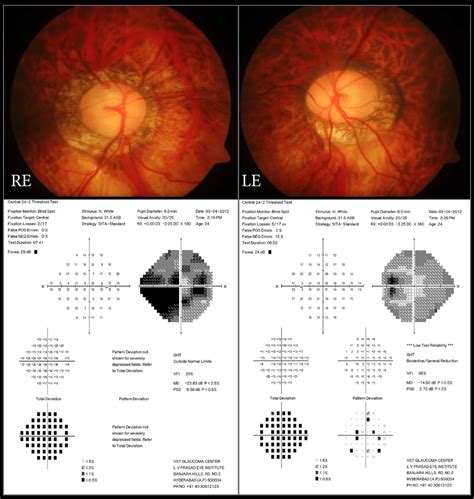 Optic disc photographs of the right eye (RE) and the left eye (LE) of... | Download Scientific ...