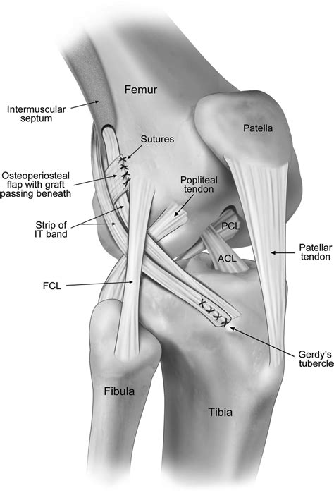 Macintosh Technique Acl Anterior Cruciate Ligament Fcl Fibular