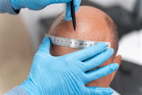 1000 Grafts Hair Transplant Cost In India Dhi International