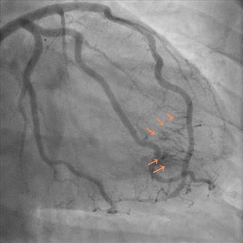 Postprandial Angina Not Always Due To Stenotic Coronary Artery Disease