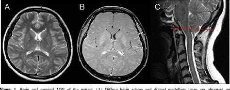 Figure 1 From A Case Of Intracranial Hypertension With