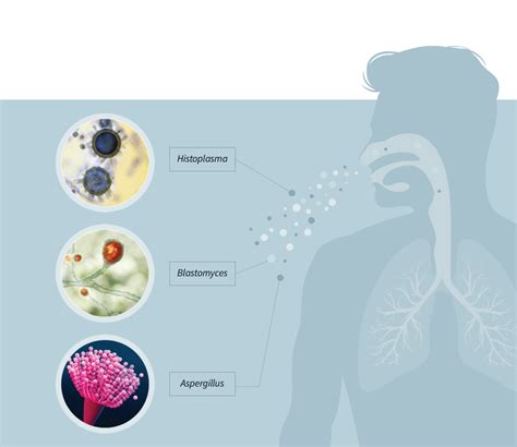 fungal infections tolsura official patient website
