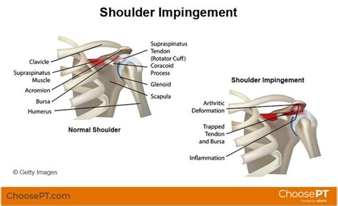 What Is Shoulder Impingement Syndrome