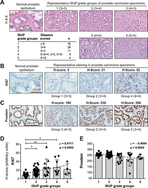 Ki67 And Prostein Staining In Pca Specimens Correlate With Tumor Download Scientific Diagram