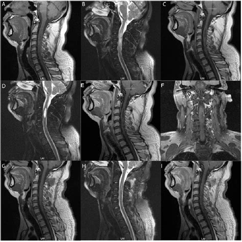 Figure 1 From Surgical Management Of A Cervical Intramedullary