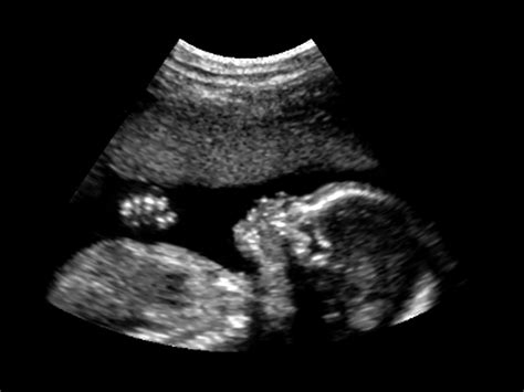 The overlooked toll of drinking alcohol while pregnant
