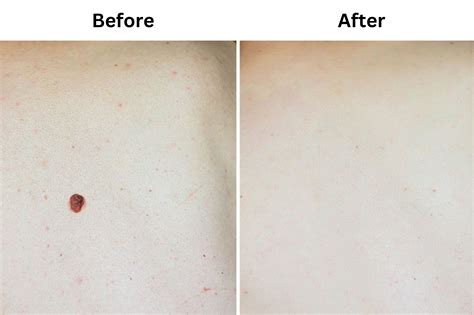 Birthmark Removal Dr Shalini Punia