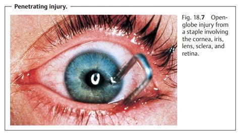 Eye Open-Globe Injuries