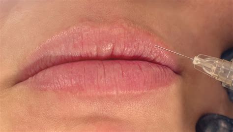 What Are Dermal Fillers And Are They Safe Dc Derm Docs