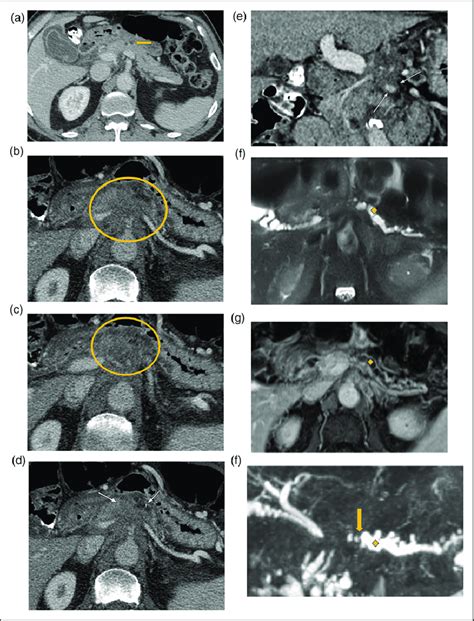 Seventy Two Year Old Male Initial Pv Phase Ct In October A Was