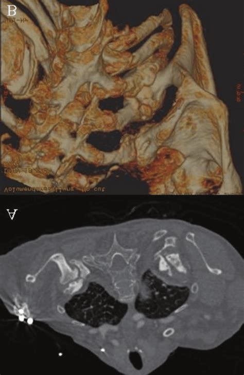 Axial A And 3d Reconstructed B Computed Tomography Scan A And B Download Scientific