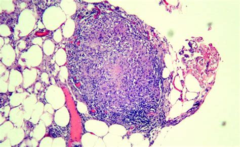 Histopathology Demonstrating Granulomas In Subcutaneous Fat Hande Download Scientific Diagram