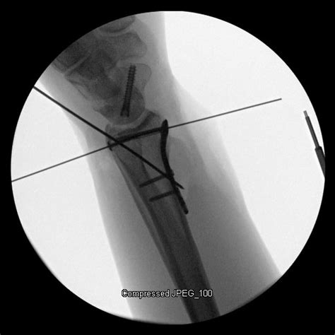 Acu Loc Wrist Plating System Acumed