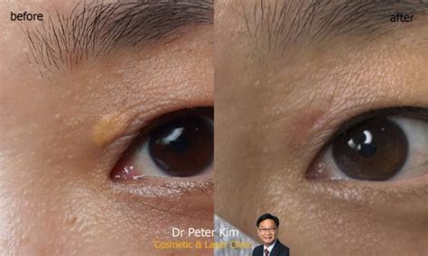 Laser Xanthelasma Removal Dr Peter Kim Surgery Skin Cancer