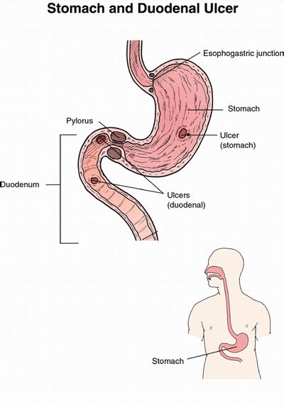 ULCER DUODENAL image galleries - imageKB.com