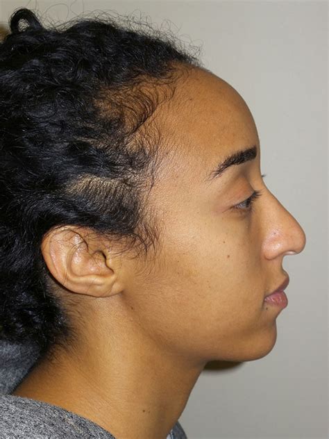 Rhinoplasty Before And After Grover Aesthetics