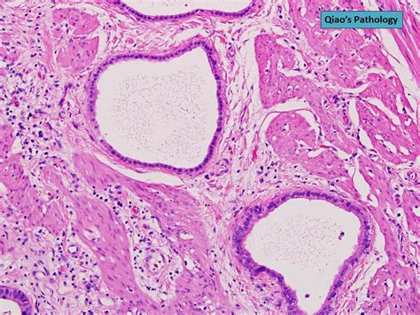 Qiao S Pathology Adenomyomatosis Of The Gallbladder A Photo On