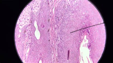 Superficial Perivascular Dermatitis