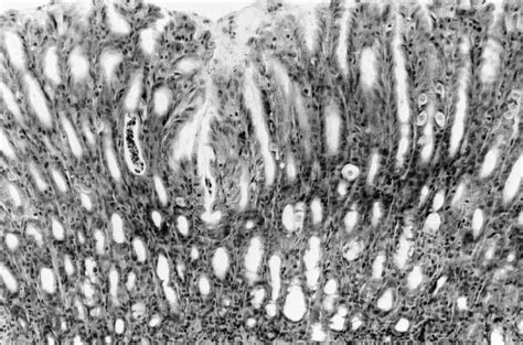 Foveolar hyperplasia with the marked dilatation of gastric glands in ...