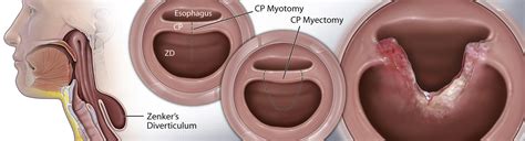 Comparison Of Flexible Endoscopic Cricopharyngeal Myectomy And Myotomy