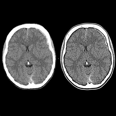 Subdural Hematoma Infant