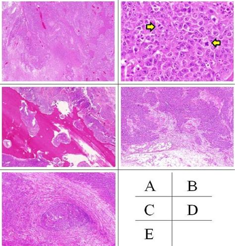 Pathological Findings Hematoxylin Eosin He Staining Abcd Download Scientific