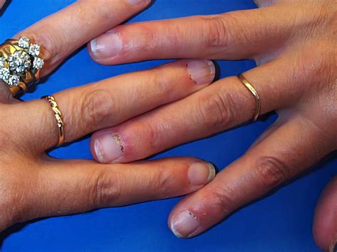 Rheumatoid Arthritis Ra Rash Pictures Causes Treatment