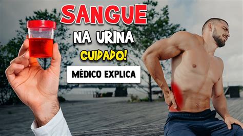 10 CAUSAS de SANGUE NA URINA Médico Explica YouTube