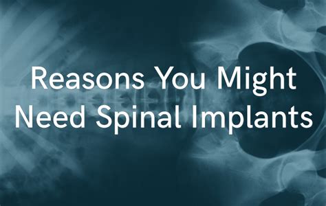 What Are Spinal Implants Orthopedic Laser Spine Surgery