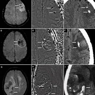susceptibility weighted imaging  glioma update  current imaging