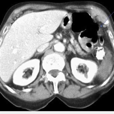 Abdominal Ct Scan Frame Showing The Splenic Injury Caused During The