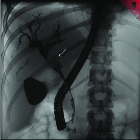 Endoscopic Retrograde Cholangiography Showing Soft Tissue Mass Arrow