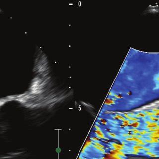 Three Dimensional Transesophageal Echocardiographic Image Of Accessory