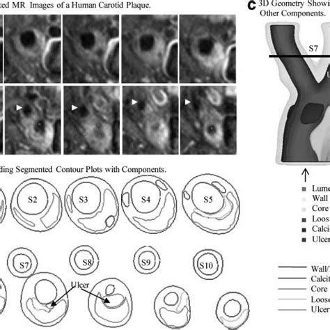 PD Weighted MR Images And Segmented Contour Plots Showing The 3D