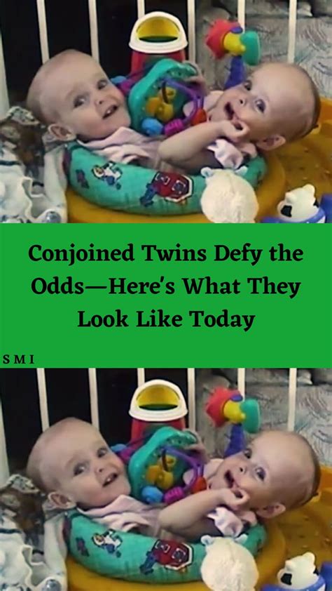 Conjoined Twins Defy The Odds—heres What They Look Like Today In 2023 Conjoined Twins Twins