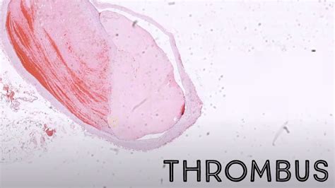 Blood Clot Under The Microscope Fibrin Thrombus Pathology Dermpath