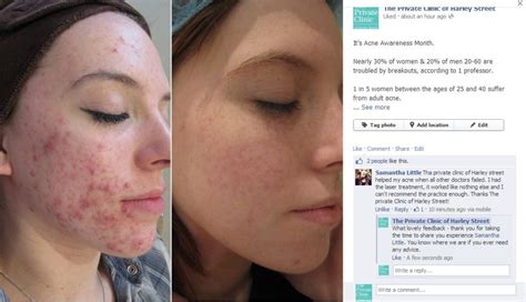 Acne N Lite Laser Treatment Vs Roaccutane Ulike Der Blog