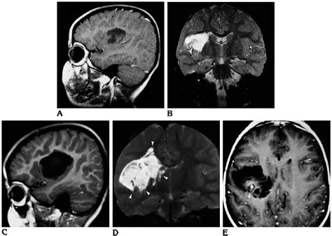 Right Insular Dnt Patient 10 Ad Mr Images From 1991 A B Show