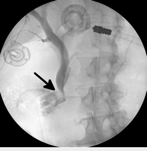 Intraoperative Cholangiogram Following Glucagon Administration In