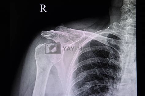 chest xray of a patient with old ribs fracture by Nawoot Vectors ...