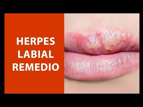 Como Quitar Los Fuegos Labiales Rapidamente Remedios Para Los Fuegos