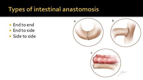 Bowel Anastomosis