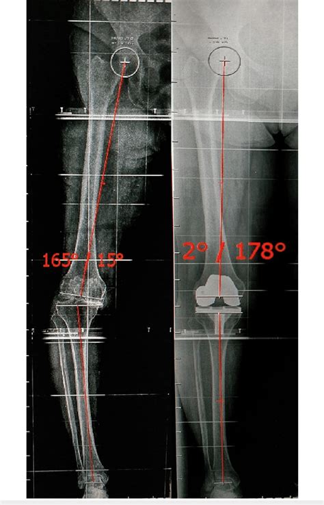 Long-leg radiograph showing measurement of the Tibiofemoral mechanical ...