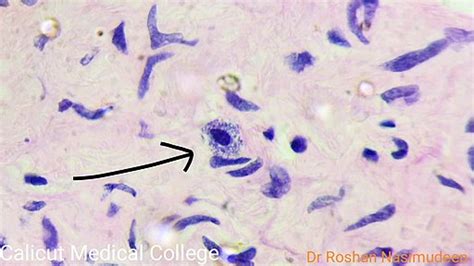 Mast Cells - Definition, Histamine/Inflammation, Vs Basophils